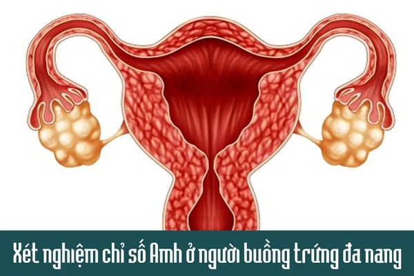 Xét nghiệm chỉ số Amh cho phụ nữ mắc buồng trứng đa nang
